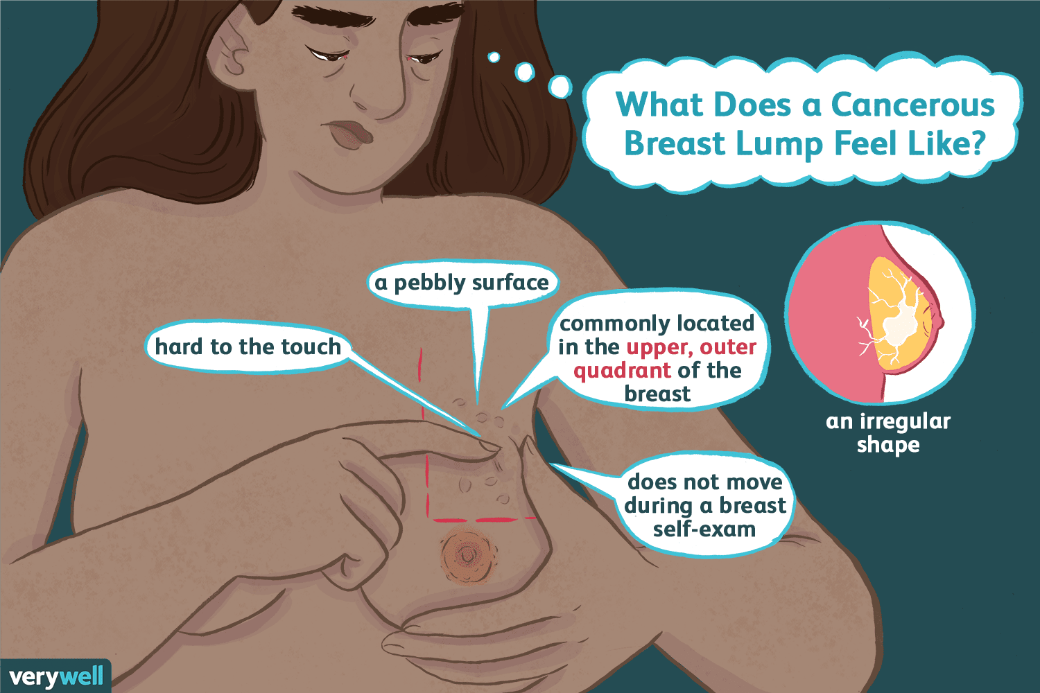 What Do Breast Cancer Lumps Feel Like