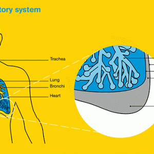 pleural mesothelioma stages Australia